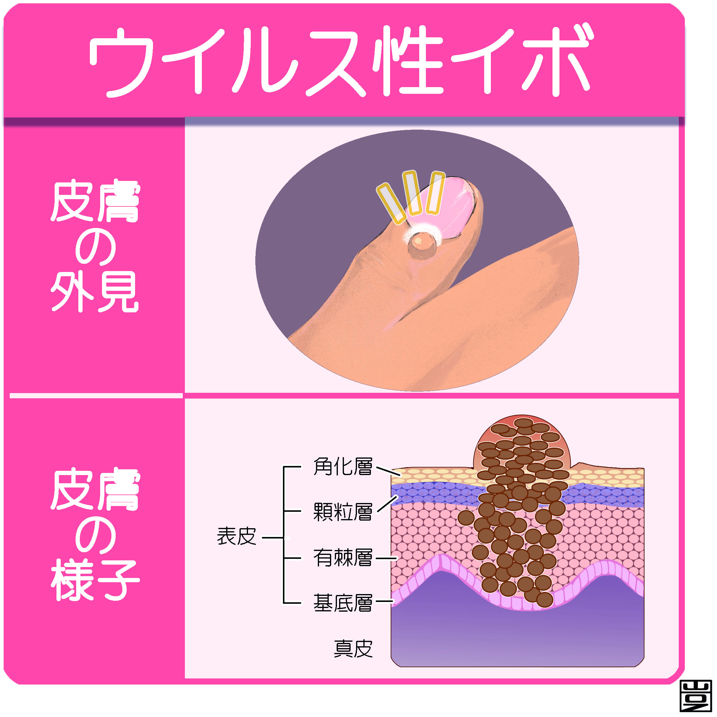 ウイルス性イボ 尋常性疣贅 とは 治療など 新宿駅前クリニック皮膚科