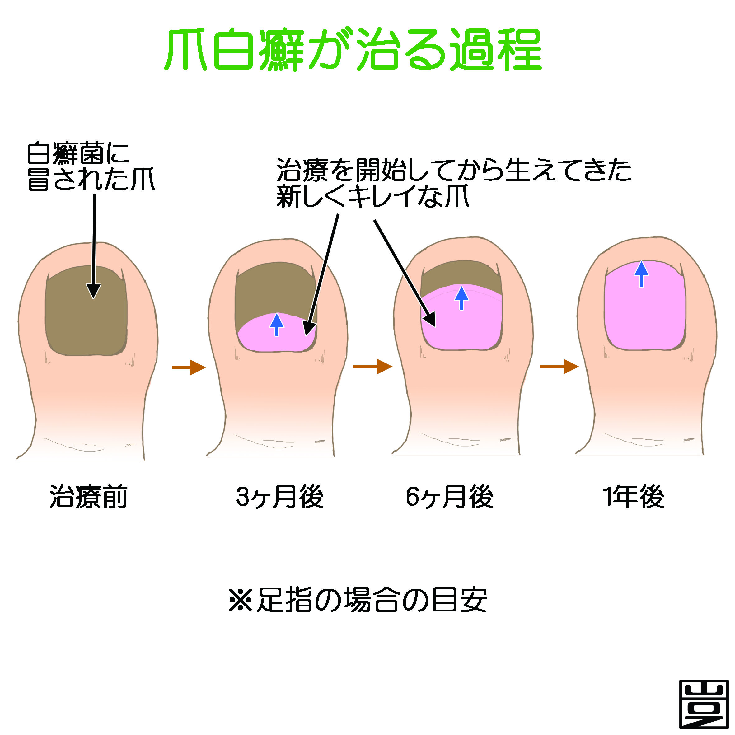 水虫 爪水虫とは 症状 治療 薬など 新宿駅前クリニック皮膚科